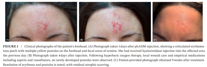Publication image of a reported vascular complication after Re2O injection