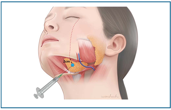 Study figure showing the vertical line from the outer corner of the eye, the lower border of the mandible, and the submandibular gland