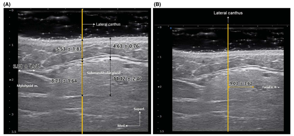Ultrasound images showing gland depth and thickness and the distance between the lateral canthus line and blood vessels